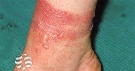 A visual representation of phytophotodermatitis, showing a rash on the skin caused by contact with a plant and subsequent sun exposure.