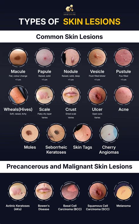 Illustration showing different types of skin spots, highlighting age spots and differentiating them from potentially cancerous lesions.