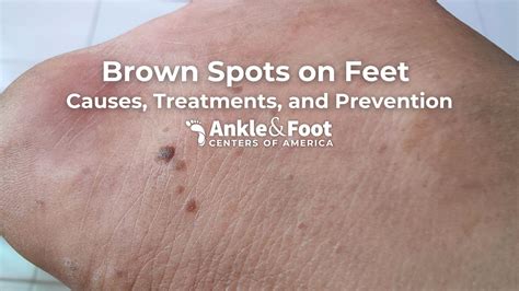 Close-up images of skin showing multiple dark spots, some clustered together, with varying sizes and shades of brown.