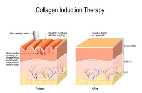 Diagram illustrating the mechanism of microneedling and collagen stimulation