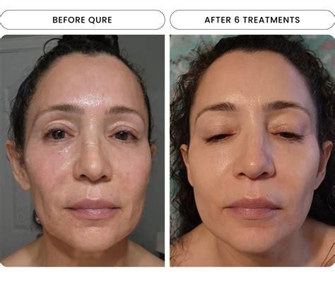 Before and after photos showcasing results from the Qure Micro-Infusion System