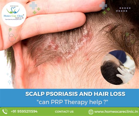 Illustration of a person with scalp psoriasis considering hair dye
