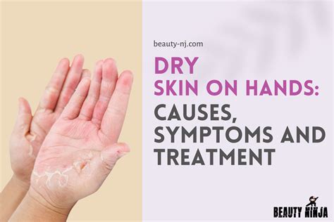 Diagram illustrating the causes and effects of dry skin on hands.