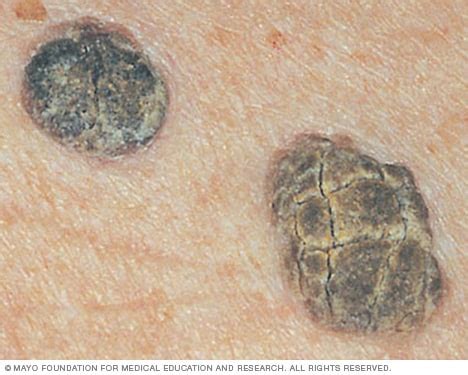 Close-up images of seborrheic keratoses showing their varied colors and 