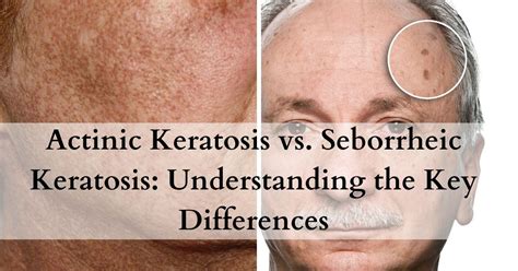 Infographic comparing the effectiveness and number of sessions required for different types of laser treatments for seborrheic keratosis.