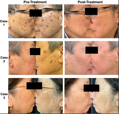 Before and after photos of seborrheic keratosis treated with laser, showing significant improvement.