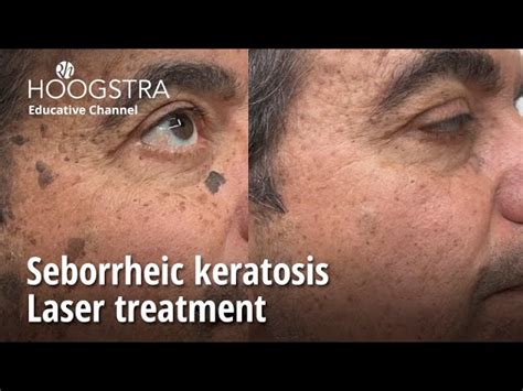 Diagram illustrating different methods of seborrheic keratosis removal: laser, hyfrecation, shave removal, and cryotherapy.