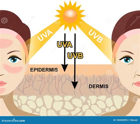 Diagram showing how UVB light therapy works to slow skin cell growth in psoriasis.