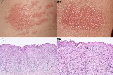 Clinical photographs of lichenoid keratosis showing varied presentations: papules, plaques, and different colorations (brown, pink, red).