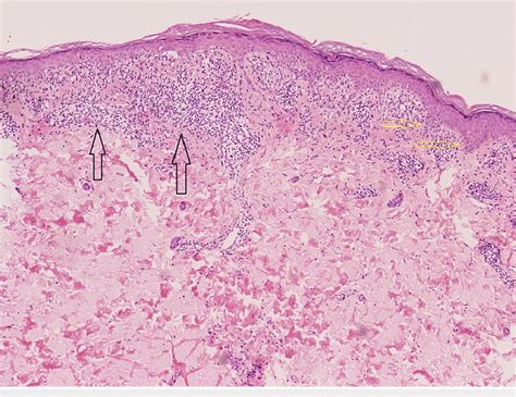 Histopathology slide showing a band-like lymphocytic infiltrate at the dermal-epidermal junction characteristic of lichenoid keratosis.