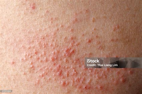 Close-up image of a localized rash on skin, illustrating redness and irritation