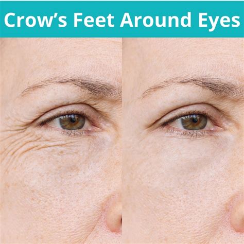 Infographic illustrating the different types of wrinkles around the eyes (crow's feet, under-eye lines, eleven lines) and how the eye concentrate targets them.