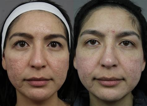 Before and after photos showing reduced pore size and acne scars from retinol use