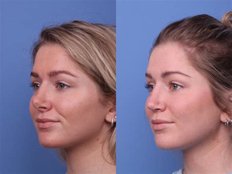 Before and after photos of individuals who have undergone rhinoplasty.