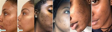 Before and after images showcasing the lightening effect of kojic acid soap on dark spots