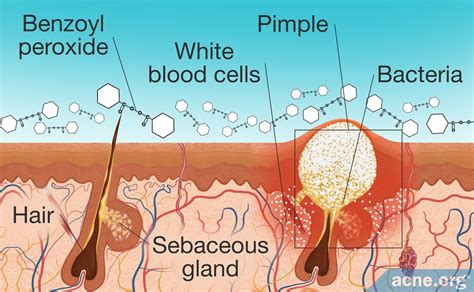 Diagram illustrating how benzoyl peroxide penetrates pores to kill acne-causing bacteria.