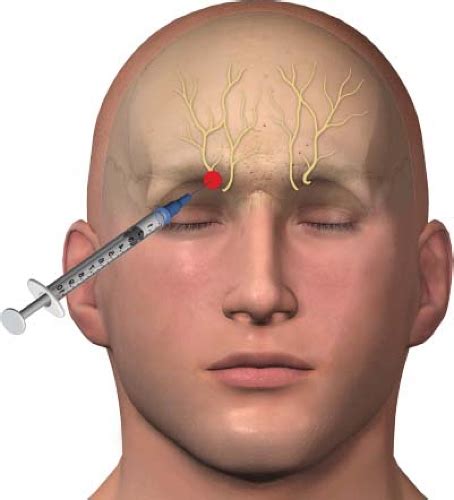 Diagram illustrating supraorbital injection for ophthalmic nerve block