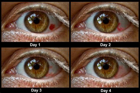 Illustration showing the color progression of a healing subconjunctival hemorrhage: red to brown/purple to yellow.