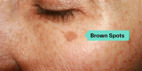 Close-up image showing the texture and color variation of age spots on skin.