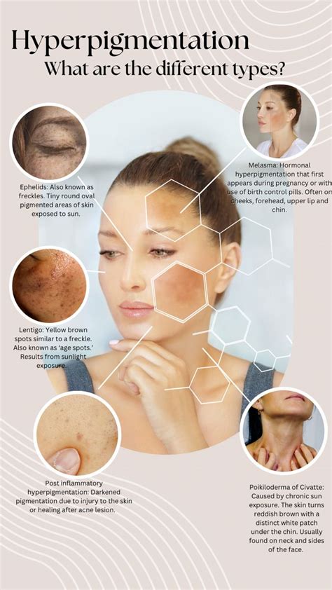 Infographic illustrating the different types of hyperpigmentation and their common locations on the skin.