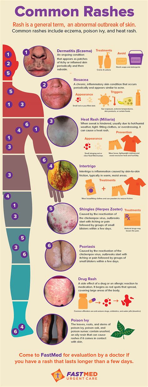 Infographic showing a flowchart for diagnosing and treating common skin rashes, including ringworm