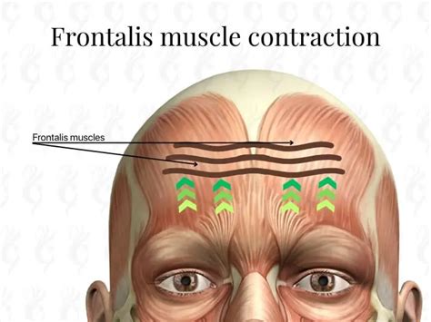 Infographic illustrating the frontalis muscle contracting and causing horizontal forehead wrinkles.