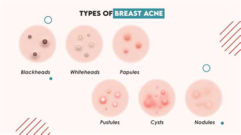 A visual representation of the progression of acne during the breast milk trial, showing before and after images (illustrative).