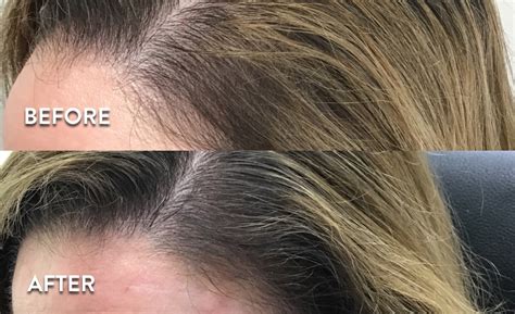 Before and after photos of PRP hair restoration treatments