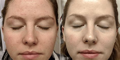 Collage of before and after photos showcasing significant improvement in acne and skin texture after blue light therapy.
