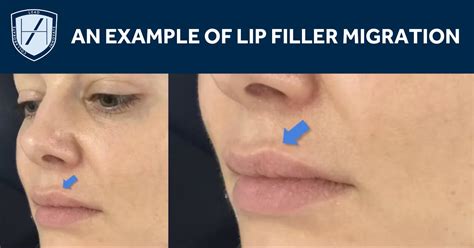 Diagram illustrating the potential migration paths of lip filler from the intended injection site to surrounding areas, such as above the lip line or towards the nose.