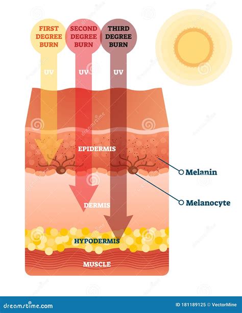 Illustration of skin layers and sun damage