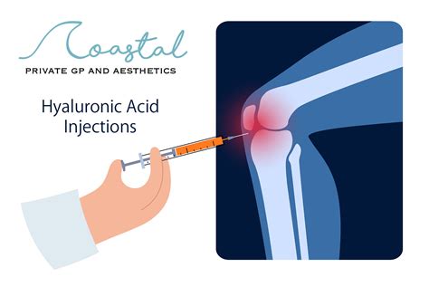 An illustration showing a knee joint with hyaluronic acid injection being administered.