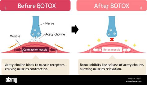 Illustration showing the mechanism of Botox action in the penile tissue, highlighting smooth muscle relaxation and increased blood flow.