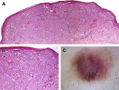 Dermoscopic image showing features suggestive of Spitzoid melanoma, such as structureless areas and atypical vascular patterns.