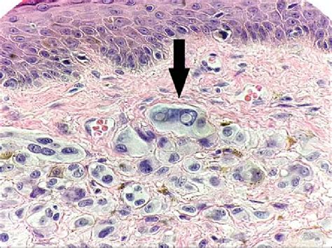 Microscopic image showing epithelioid melanocytes with prominent nucleoli, characteristic of Spitzoid lesions.