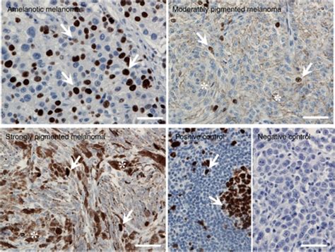 Immunohistochemical staining showing differential expression of markers (e.g., HMB-45, Ki-67) in Spitzoid melanoma.