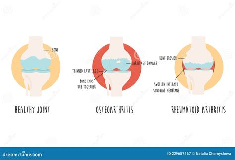 Diagram of a healthy vs. arthritic knee joint