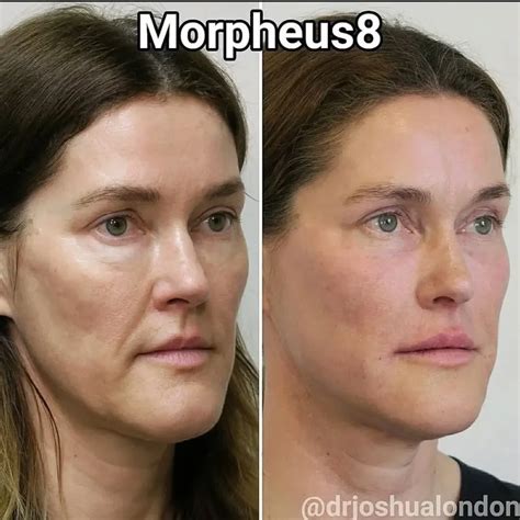 Collage of Morpheus8 BODY before and after photos showing thigh, abdomen, and arm transformations