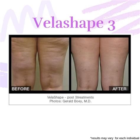 Genuine, unretouched before and after pictures of LipoTherapeia® cellulite and skin tightening treatments on thighs and buttocks