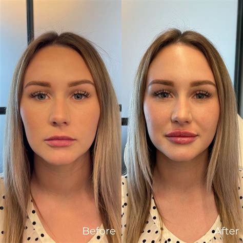 Before and after images showcasing the effects of dermal fillers on wrinkles, volume loss, and lip enhancement