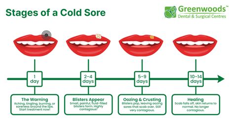 Infographic showing the stages of a cold sore and recommended treatments for each stage
