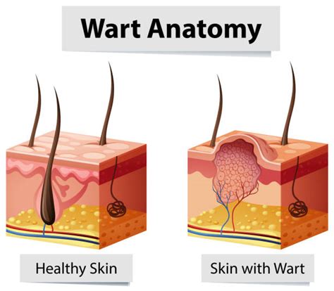 Illustration showing the different layers of skin and where a plantar wart forms.