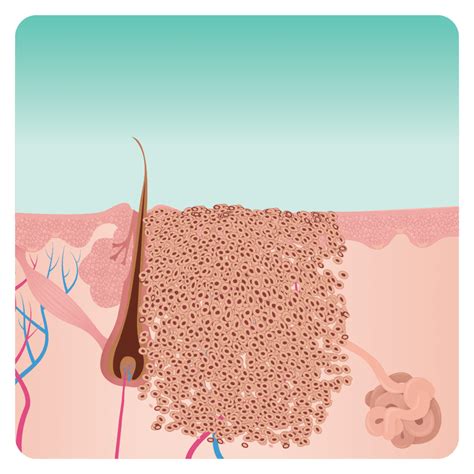 Diagram illustrating how microwave energy targets wart tissue and stimulates an immune response.