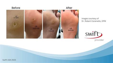 Infographic comparing success rates and side effects of Swift therapy with traditional wart treatments.