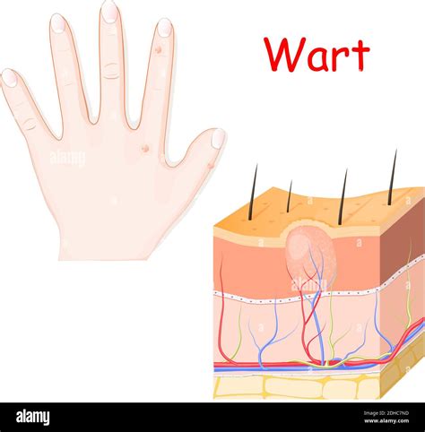 Illustration of a wart on a finger
