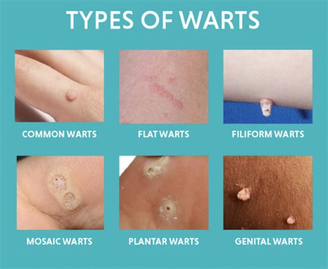Infographic showing different types of warts and their common locations