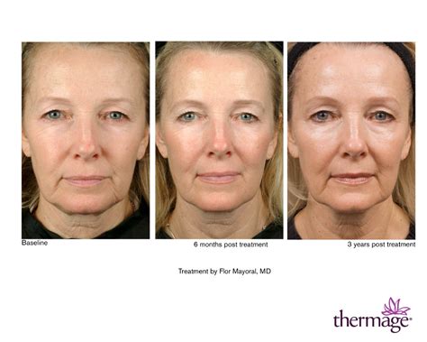 A collage of diverse patient before and after photos showcasing different facial rejuvenation results from Thermage FLX treatment.