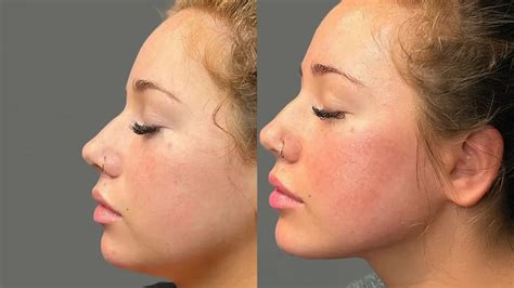 A bar chart visually representing average improvements in jowl definition and jawline contouring for patients aged 50-70 after Thermage FLX treatment.