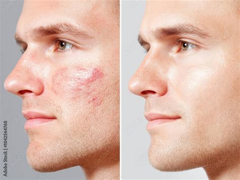 Close-up comparison photos showing the reduction in acne scar depth and improvement in skin texture after Thermage FLX treatment.