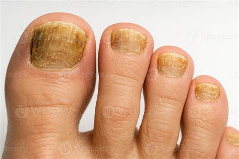 Close-up of a toenail affected by fungal infection, showing discoloration and thickening.